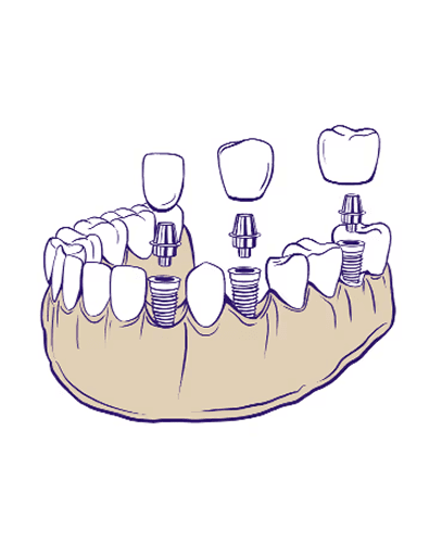 All-on-4 & 6 Dental Implants