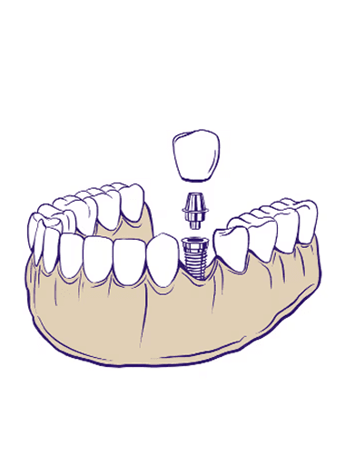 Single Tooth Dental Implants