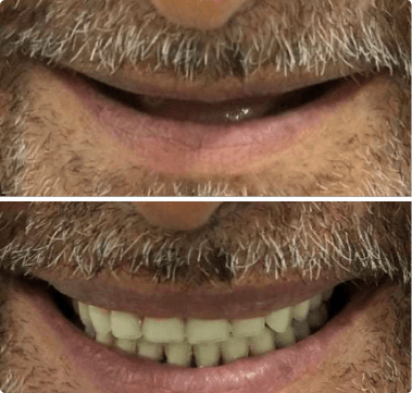 dental implants before and after