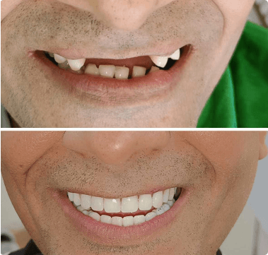 dental implants before and after image