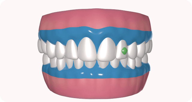 tooth surface preparation & etching