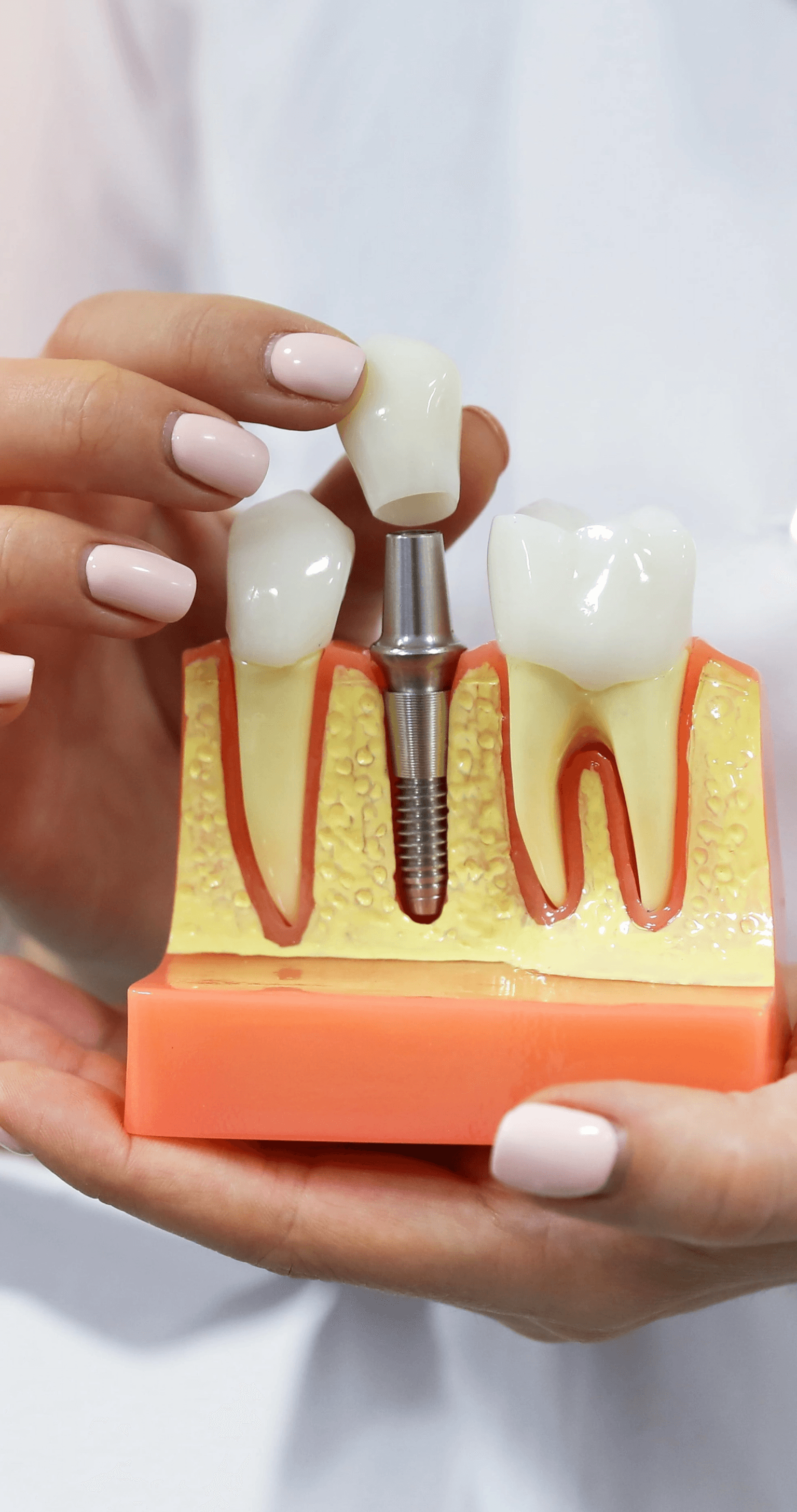 dental implants benefits at Dezy